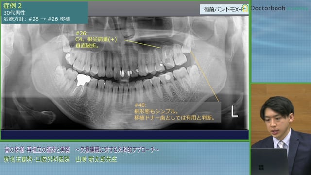 歯の移植にドナー歯のレプリカを用いるメリットと移植の成功基準│山崎 新太郎先生 #6