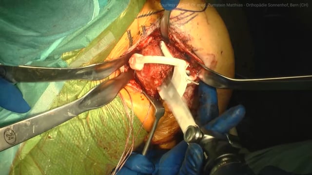 Medacta Shoulder System Stemless Anatomic using MyShoulder guides: live surgery - Prof. Dr. med. Matthias Zumstein