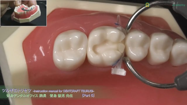 臼歯ダイレクトボンディング デモンストレーション(大臼歯部 2級窩洞) #5