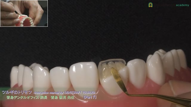 前歯ダイレクトボンディング デモンストレーション(死腔なく充填する方法) #7