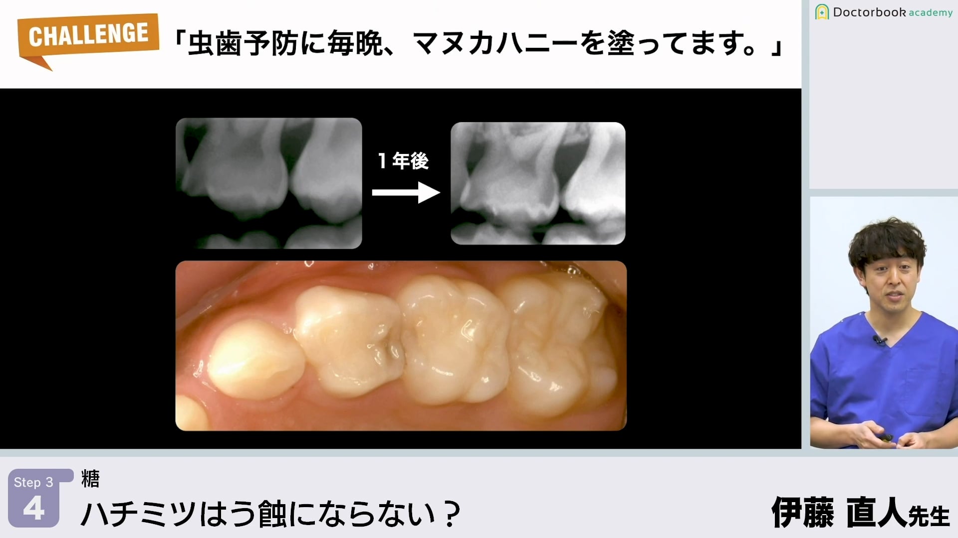 ハチミツはう蝕にならない？│Step3-4