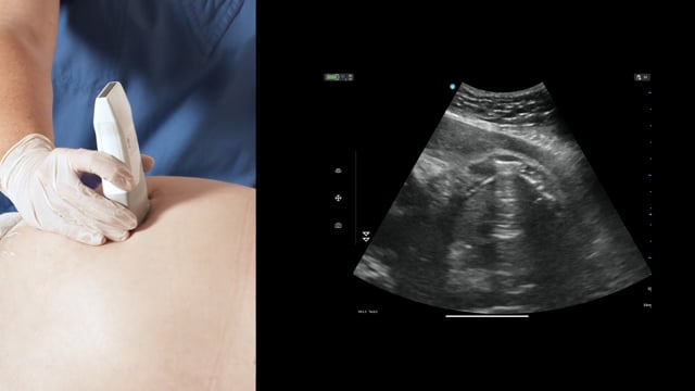 How to find the fetal heart in transabdominal ultrasound