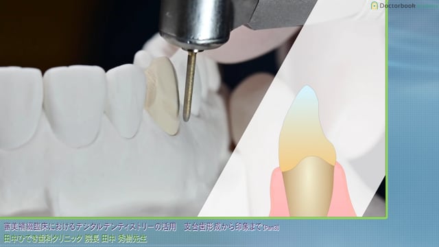 IOSによる歯肉貫通形態の再現｜臨床を用いて徹底解説 #3