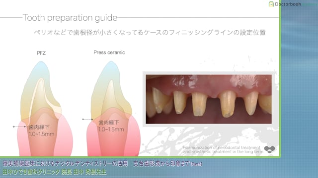 支台歯形成と咬合の基本