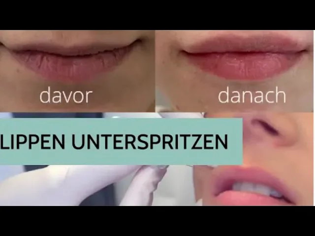 Lippenkorrektur – Möglichkeiten und Grenzen!