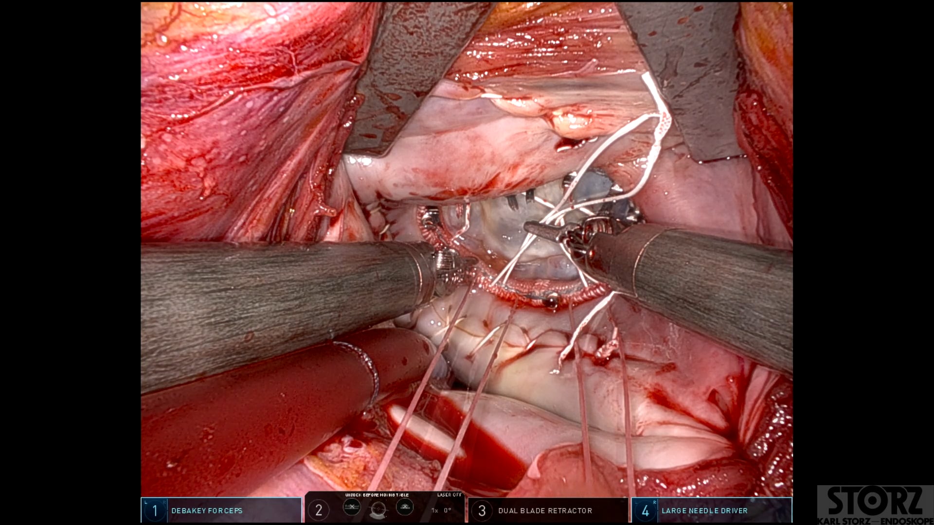 Double Papillary Muscle Relocation: A Totally Endoscopic, Robotic ...