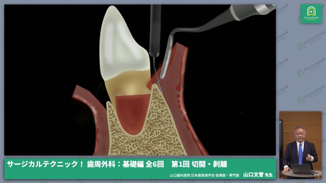 サージカルテクニック！ 歯周外科：基礎編 第1回 切開・剥離