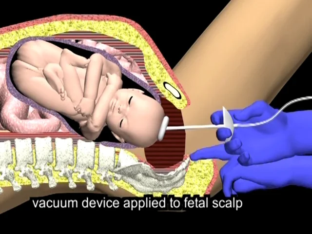 Vacuum Delivery Video