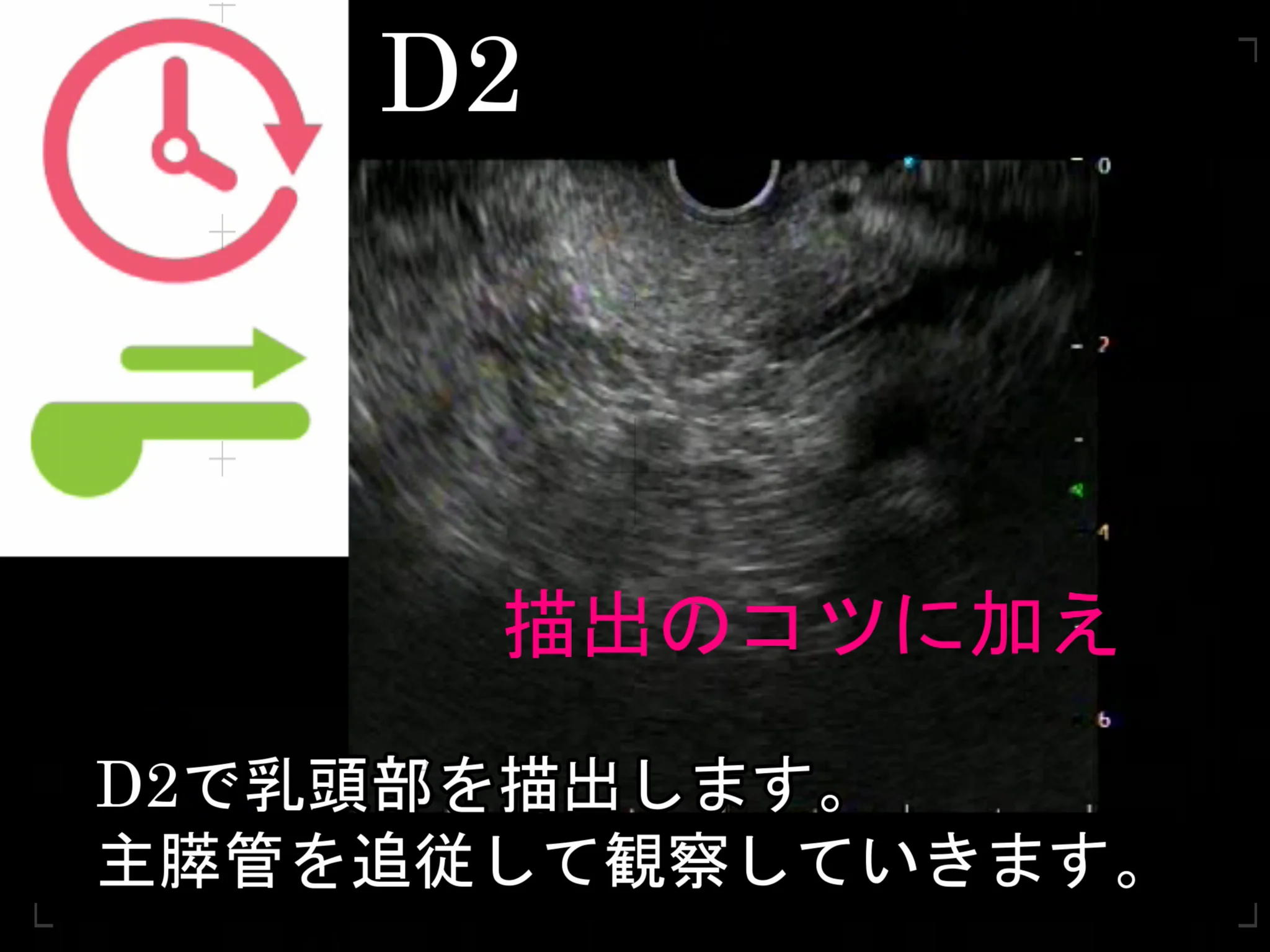 へるす出版 改訂第2版 胆膵EUS教本