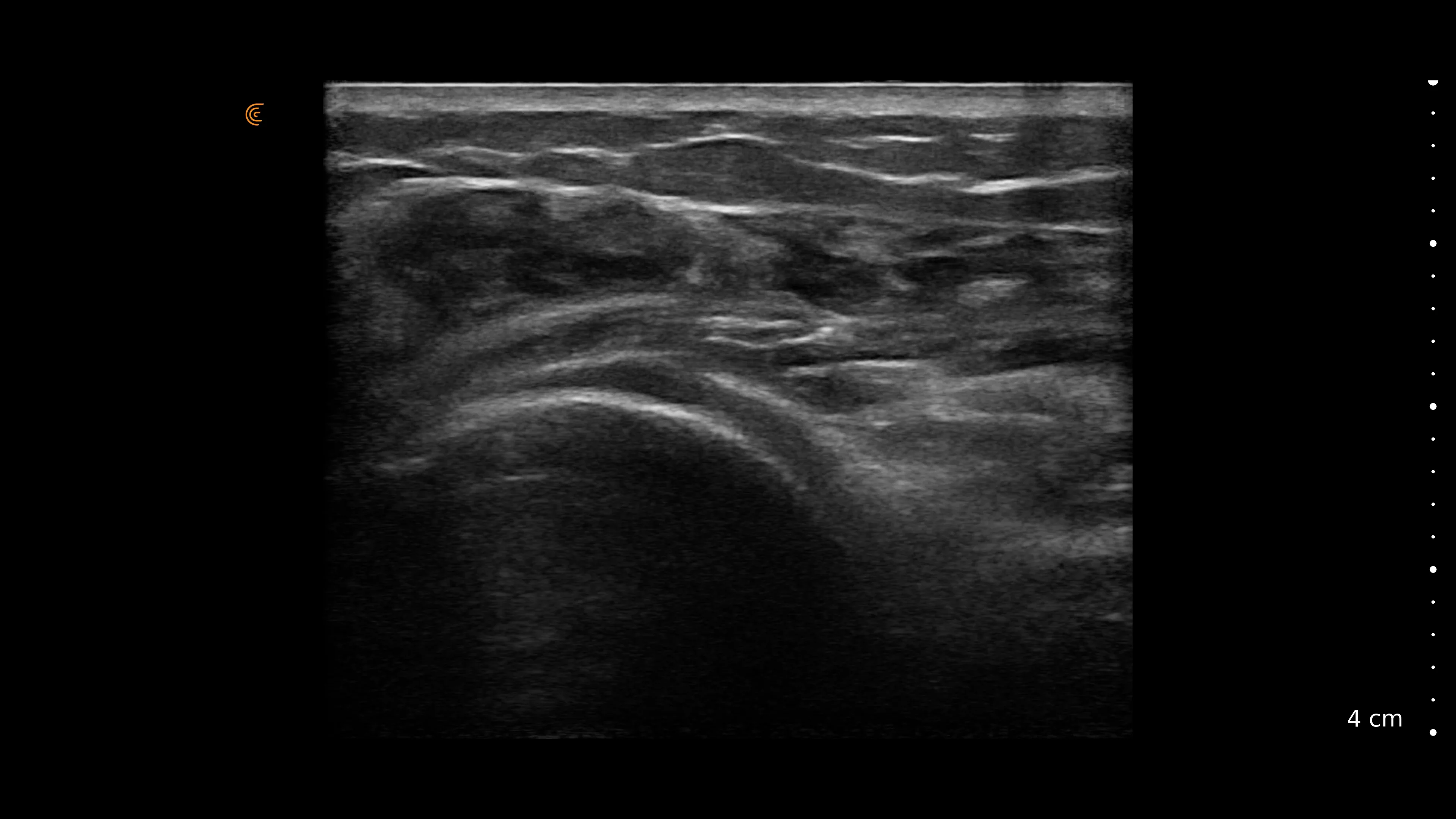 Frozen Shoulder Ultrasound Guided Steroid Injection on Vimeo