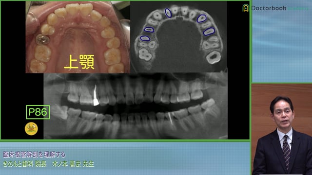 上顎前歯部の歯種別要点│根管形成でS字にならないコツと治療方法 #3
