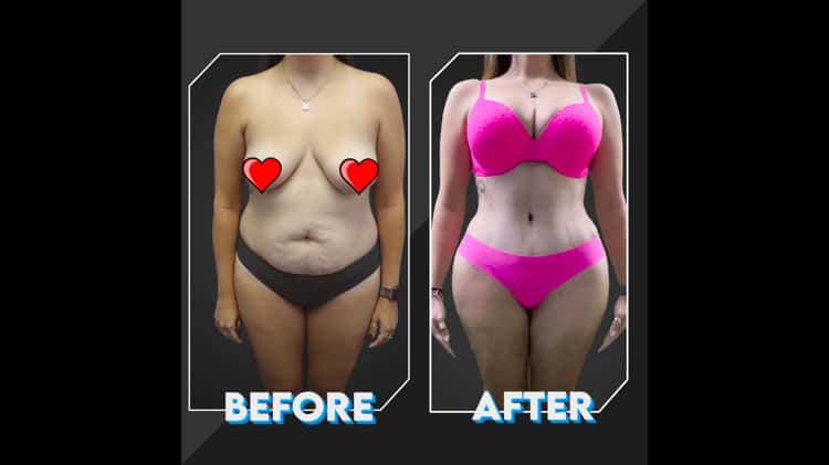 Best candidates for the hourglass tummy tuck - Hourglass Tummy Tuck