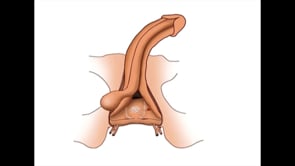 PRESERVACIÓN DE LA ARTERIA BULBAR DURANTE LA RECONSTRUCCIÓN DE LESIONES URETRALES POR FRACTURA PÉLVICA (PFUI)
