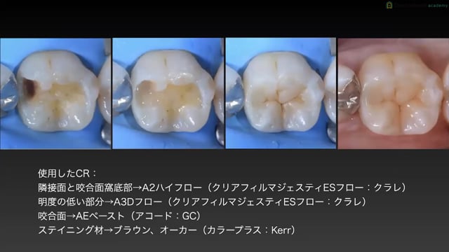 コンポジットレジン修復における形態や表面性状の影響│前歯・臼歯の形態とⅠ級窩洞の充填 #2
