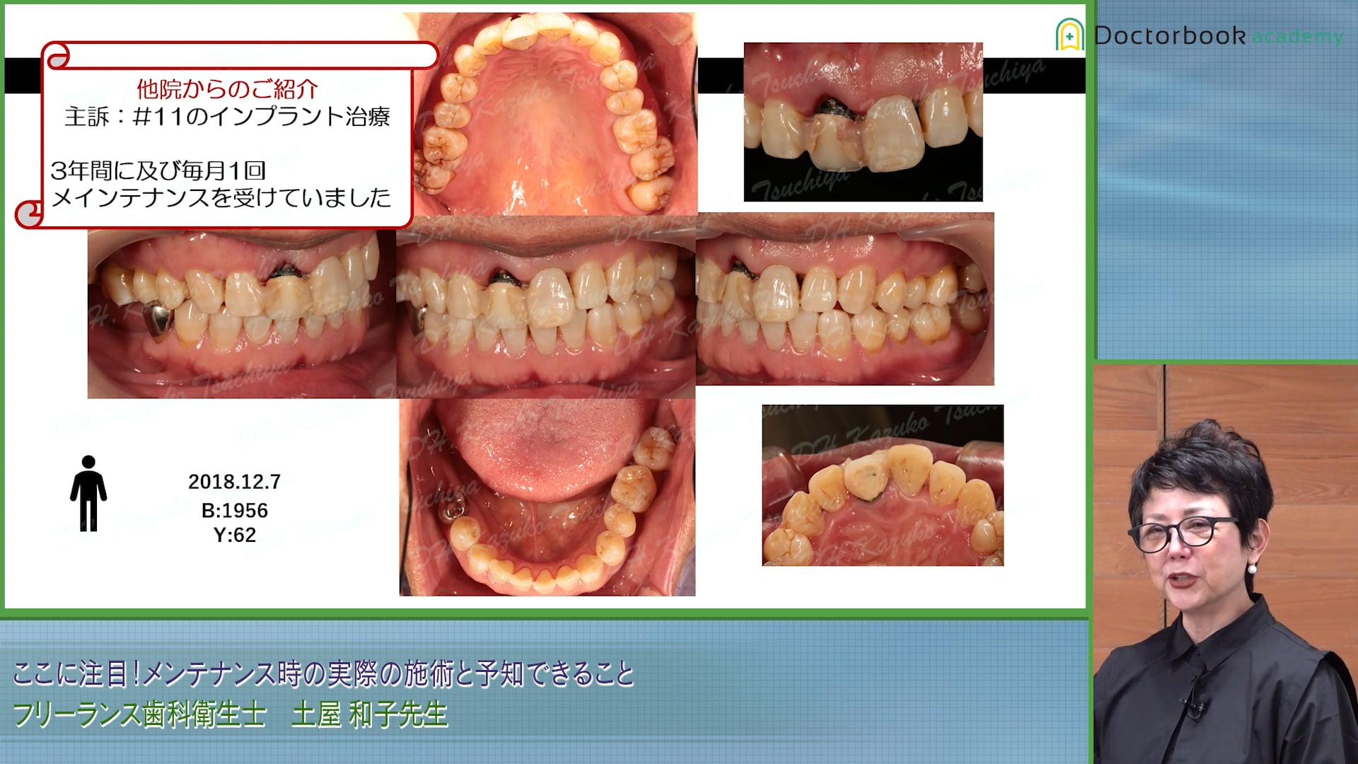 メンテナンス時の見逃しがもたらすこと #1