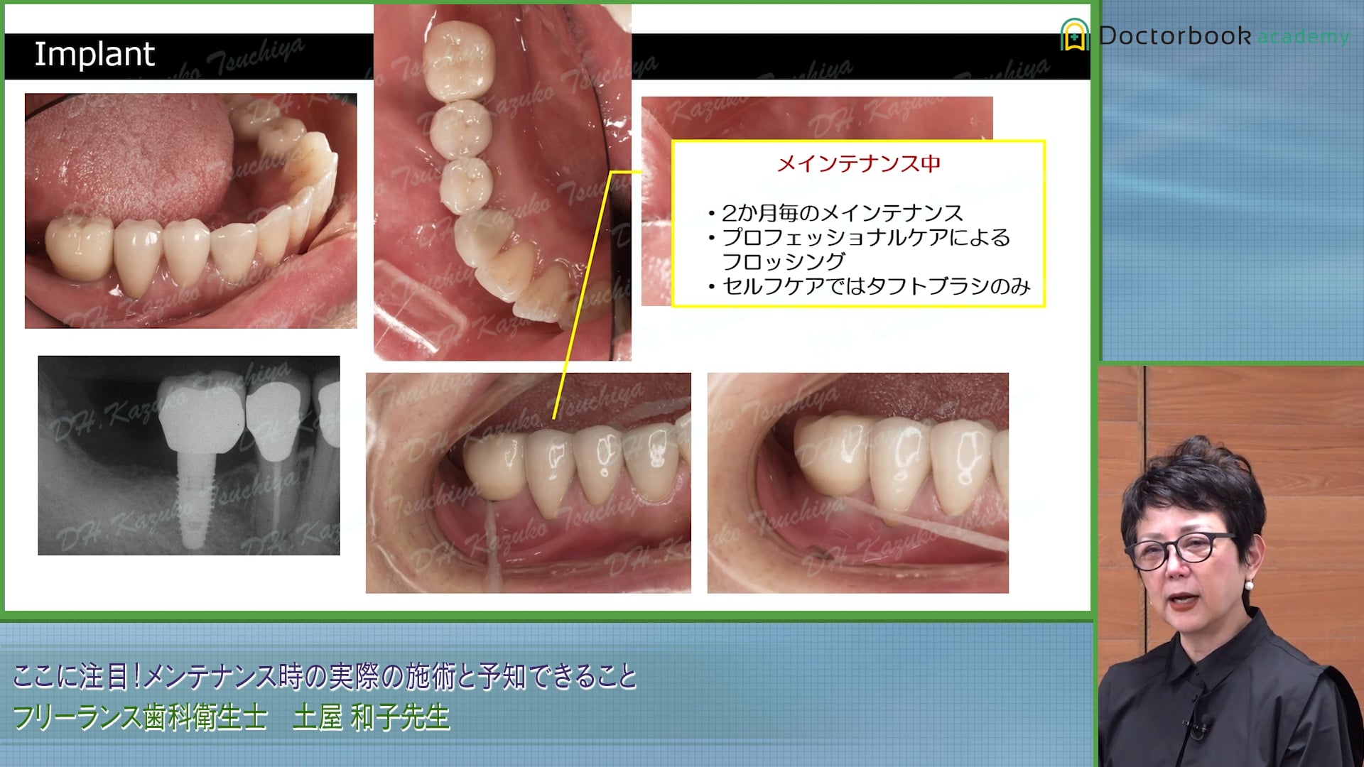 インプラント周囲炎を発症！どのようなメンテナンスをすべきか #2