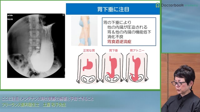 カリエス多発の原因はプラークコントロールだけ？ #3