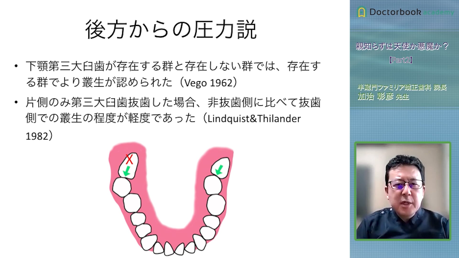 第三大臼歯は第二大臼歯への悪影響や叢生の原因となるのか？ #2