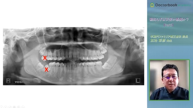第三大臼歯抜歯の代替歯としての有用性と適応症 #5