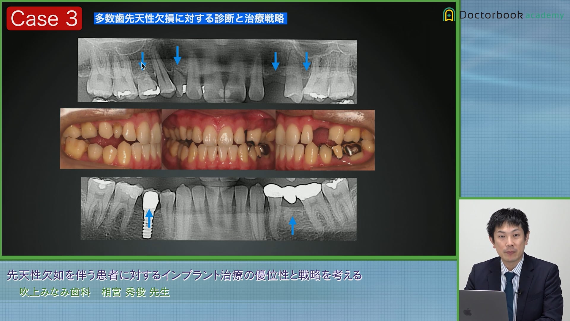 先天性欠如を伴う患者に対するインプラント治療の優位性と戦略を考える #3