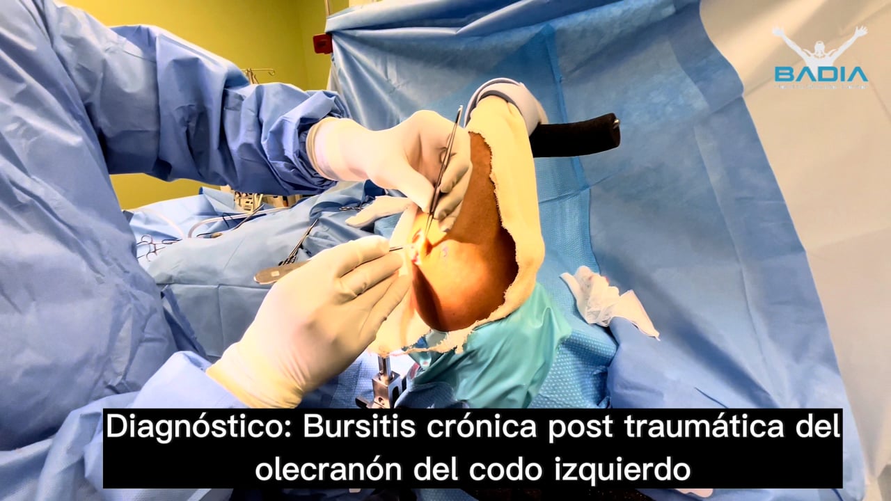 Dr. Badia performs an open bursectomy with local anesthesia and virtual reality! (No sedation)