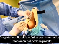 Dr.Badia realiza una bursectomia abierta con anestesia local y realidad virtual! (No sedación)
