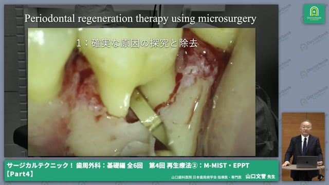 さまざまなフラップデザインを用いた歯周組織再生療法 #4