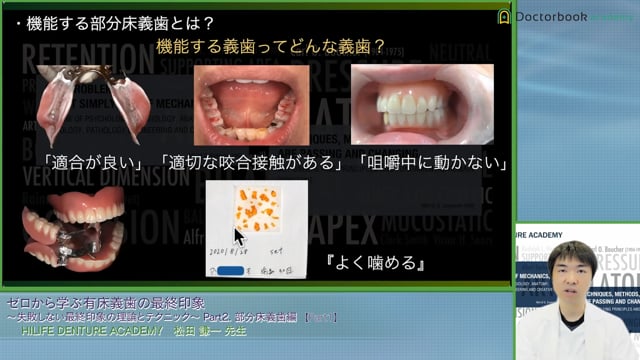 維持のメカニズムと義歯の動きからわかる部分床義歯の印象のポイント #1