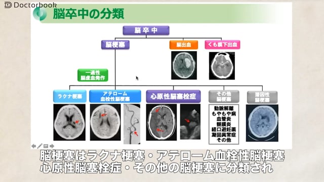 脳卒中後の認知症は改善するのでしょうか？