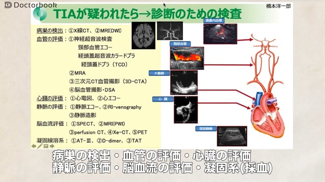 脳梗塞の前触れ？放っておくと怖い一過性脳虚血発作(TIA)