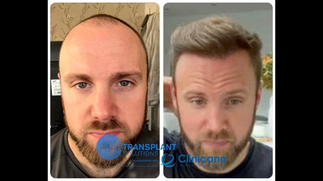Hair Transplants UK - Southport, Liverpool, Manchester