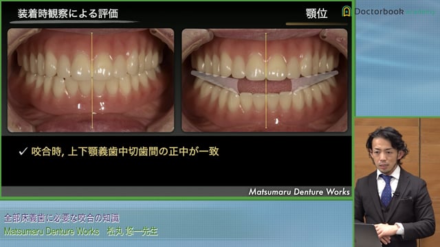 どのような咬合面形態をあたえたら干渉が起きないのか #3