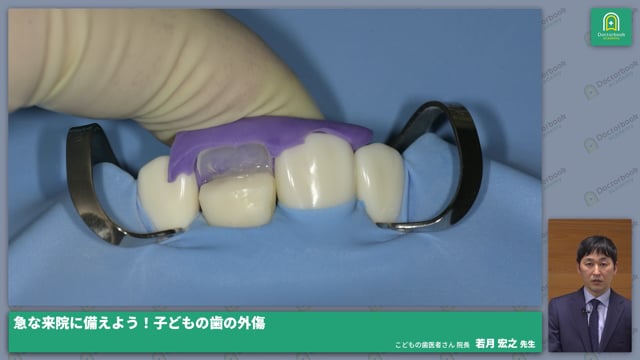 外傷歯の治療および使用器材１ー破折 #3