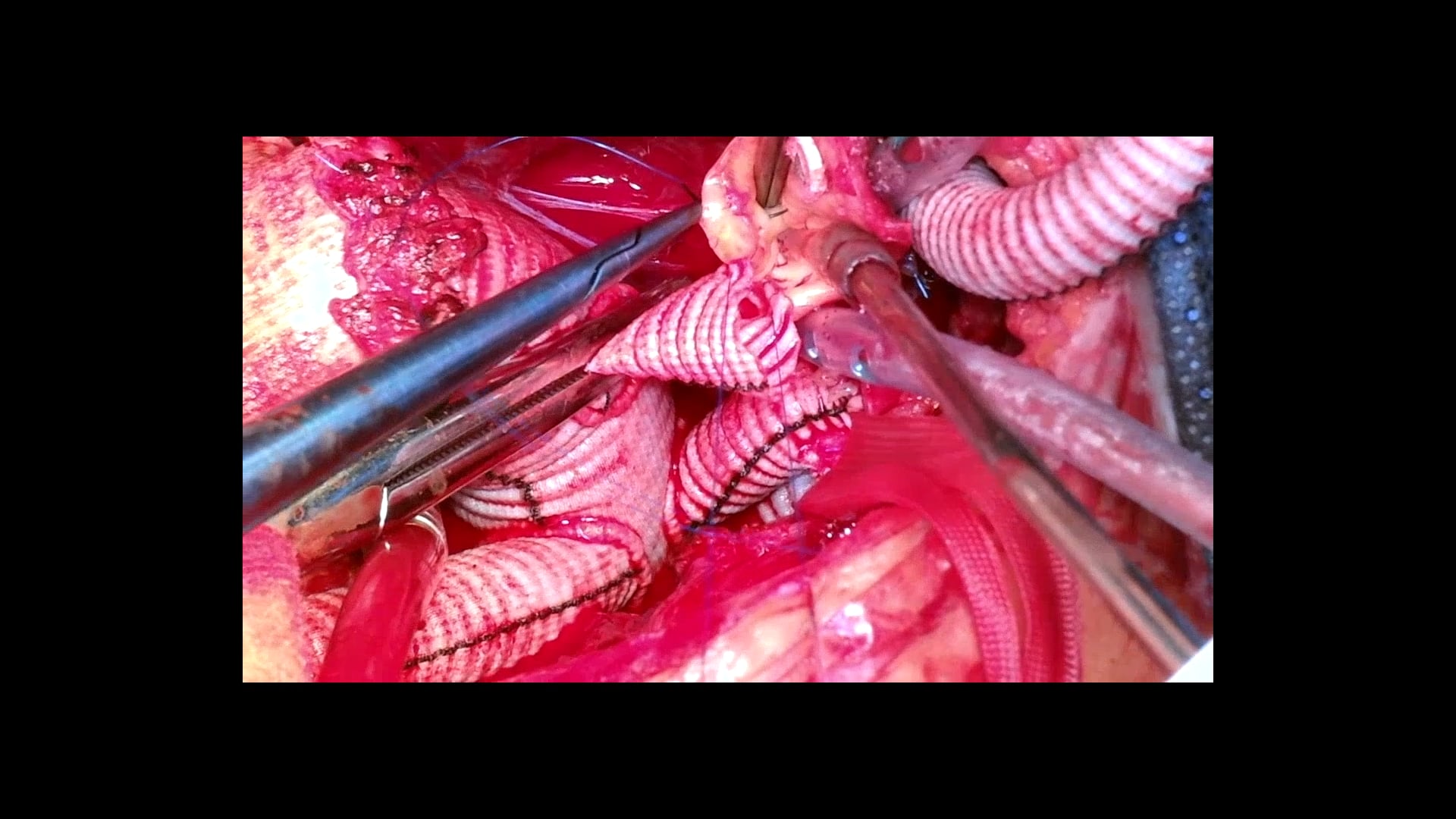 Resternotomy Aortic Root And Arch Replacement Following Previous