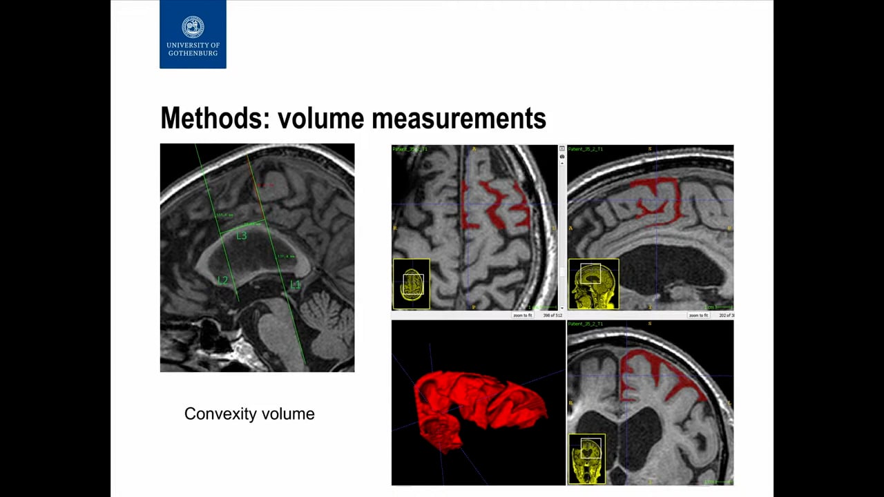 S8. Elin Eriksson Hagberg - CSF VOLUMETRY OF CEREBRAL HIGHCONVEXITY TIGHTNESS, SYLVIAN FISSURE AND VENTRICULAR VOLUME AFTER SHUNT TREATMENT IN IDIOPATHIC NORMAL PRESSURE HYDROCEPHALUS