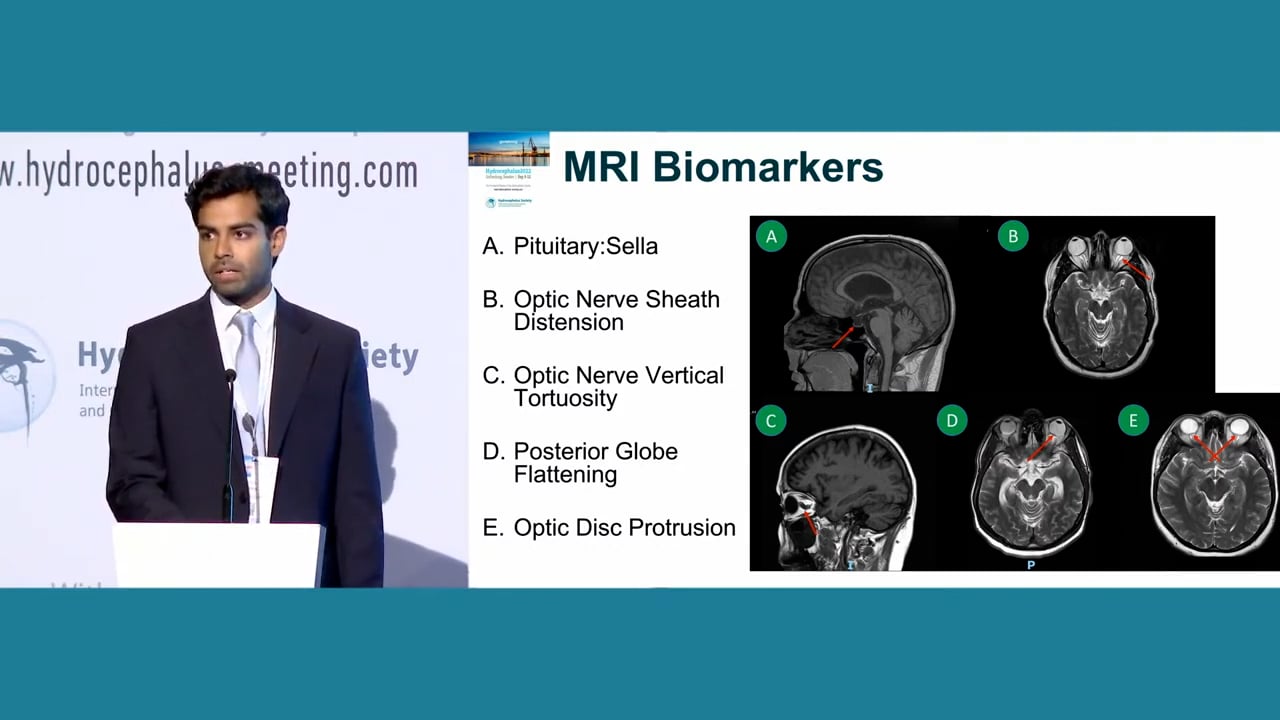 S17. Musa China - THE UTILITY AND REVERSIBILITY OF MRI BIOMARKERS IN PREDICTING RAISED INTRACRANIAL PRESSURE