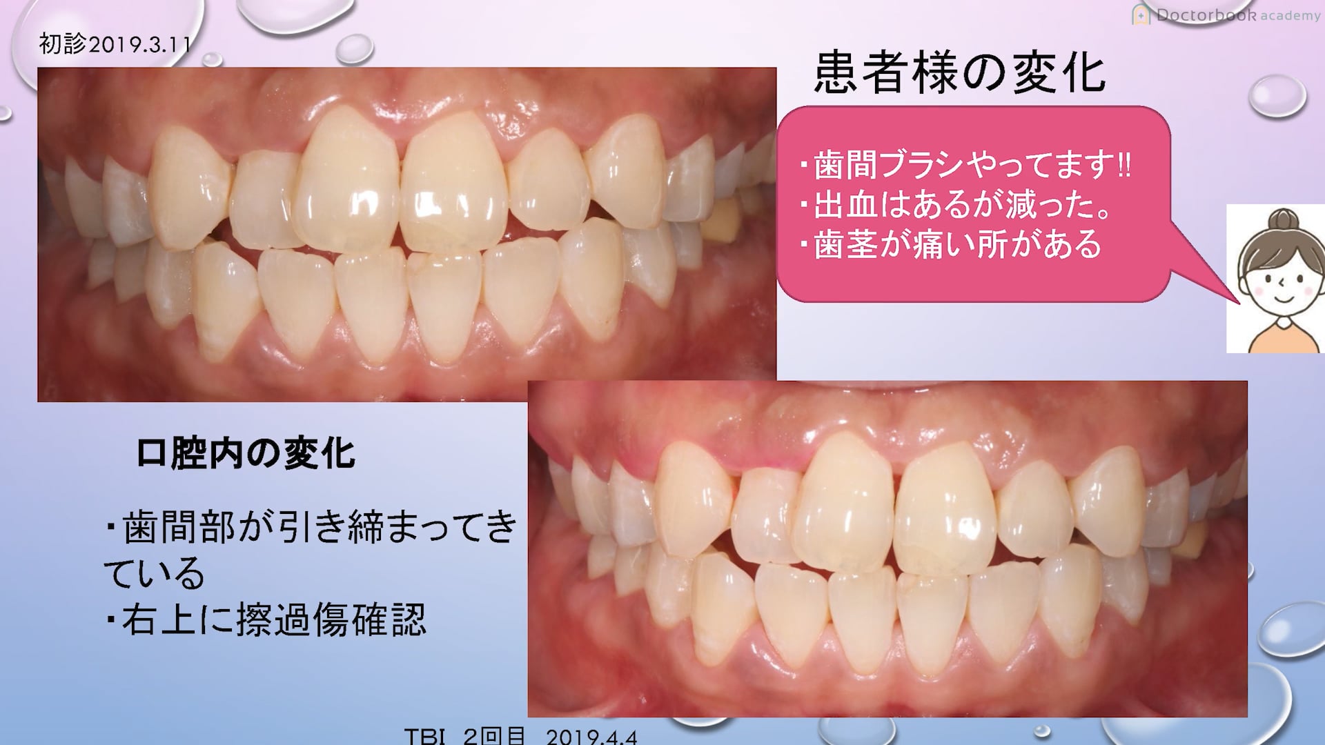 歯周基本治療で患者様の協力を得るために私達に出来ること