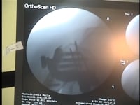 Cirugía de Hombro Reparación de Fractura de Húmero - Cirujano Ortopédico de Hombro Dr. Alejandro Badia