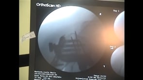 Shoulder Surgery Humerus Fracture Repair