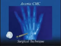 Thumb Joint Replacement Surgery Dr. Alejandro Badia Orthopedic Surgeon - thumb joint pain