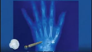 Thumb Joint Replacement Surgery Dr. Alejandro Badia Orthopedic Surgeon