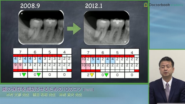 Hopeless toothへの対処とエンドペリオ病変│神成 貴夫先生 #5