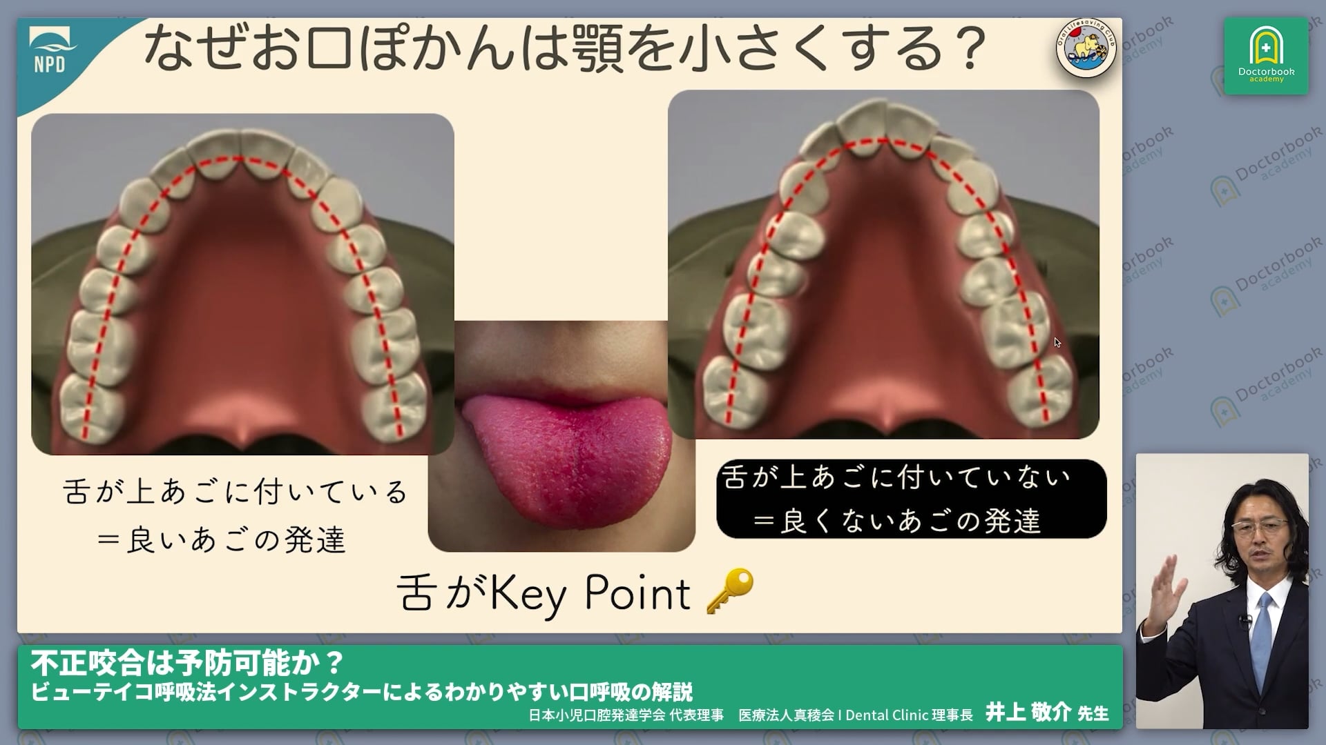 小児の発育における口呼吸の影響 #1