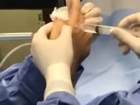 MCP Arthroscopic Debridement Scoping of a Knuckle