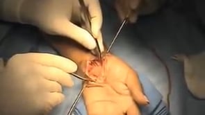 Cirugía del Tunel Carpiano Carpal Syndrome Treatment – Hypothenar Fat Flap Dr. Alejandro Badia