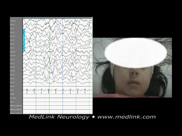 Autonomic manifestations other than ictus emeticus in girl with SeLEAS (PS)