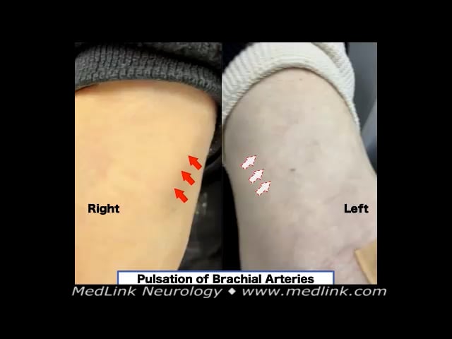 Brachial artery pulse in subclavian steal