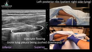 Intercostal Nerve Injection