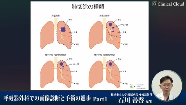 呼吸器外科での画像診断と手術の進歩　Part1