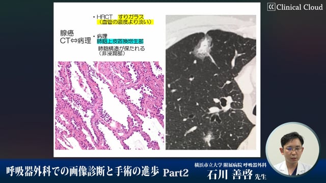 呼吸器外科での画像診断と手術の進歩 Part1 | Clinical Cloud 呼吸器外科での画像診断と手術の進歩 Part1 | Clinical Cloud